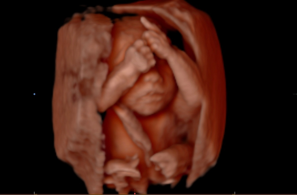 clearview-ultrasound-image-0668